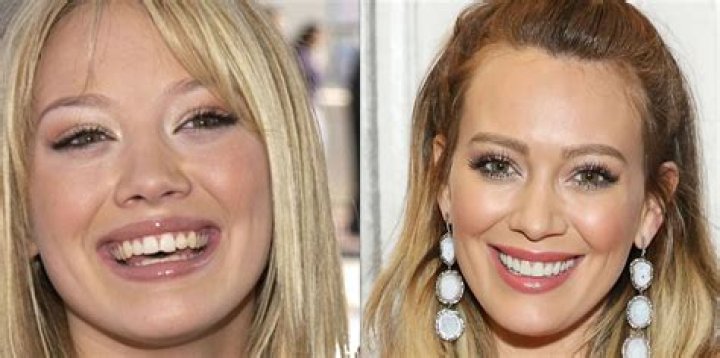 20 Celebrities Who Used to Have Horrible Teeth