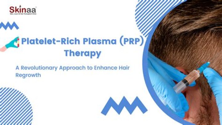 Ashley Tisdale got platelet-rich plasma treatment on her scalp for alopecia