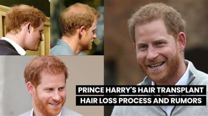 Does Prince Harry want a ‘hair transplant’ to rescue his growing bald spot?