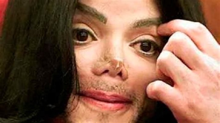 Dr. Klein admits he rebuilt Michael Jackson’s nose with injectable fillers