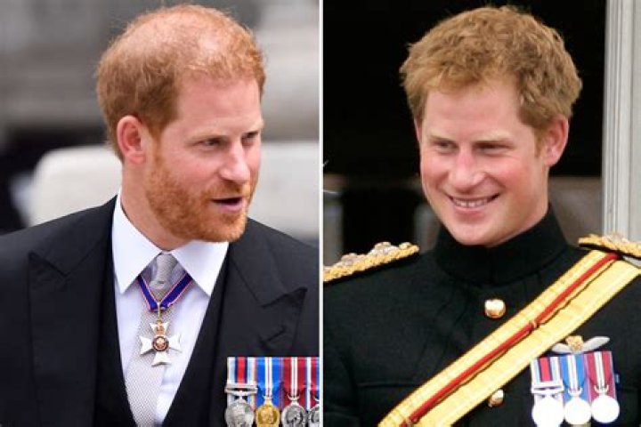 Hair-loss surgeon claims Prince Harry will be completely bald by the age of 50
