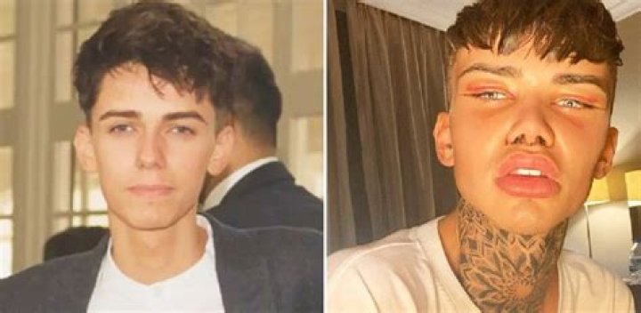 Levi Jed Murphy Before Surgery Photos, Age Height And Net Worth