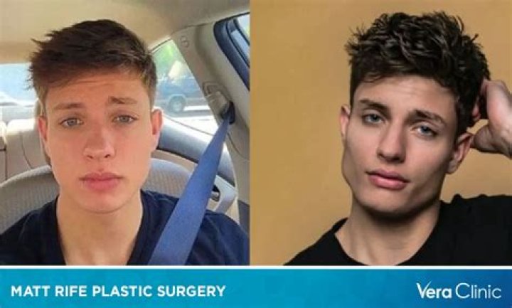 Matt Rife Pre Plastic Surgery: Before And After Plastic Surgery Photo