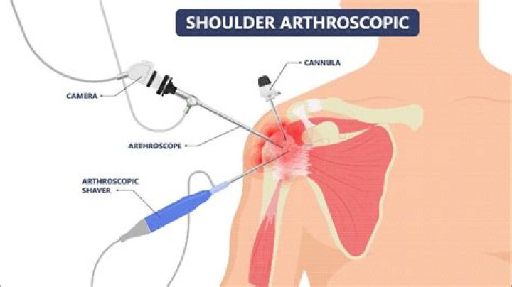 What is the CPT code for shoulder Bursectomy?